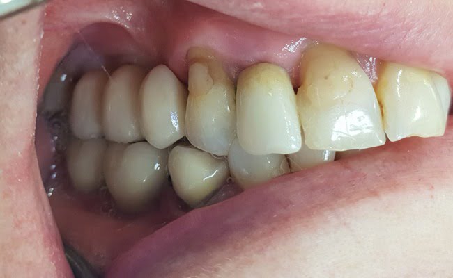 Sg Implantbridge After1