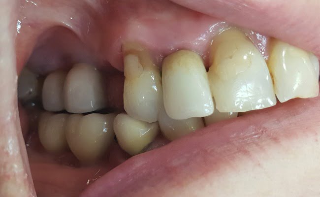 Sg Implantbridge Before1